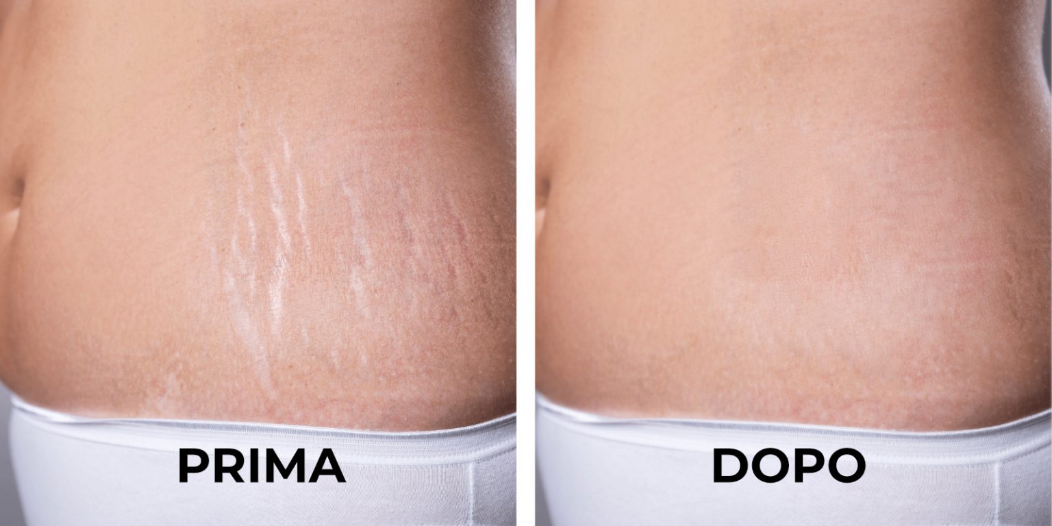 laser smagliature prima e dopo